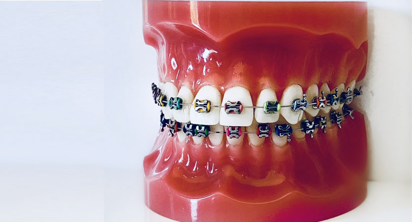 what-braces-colors-can-add-color-to-your-smile-healthy-mindz