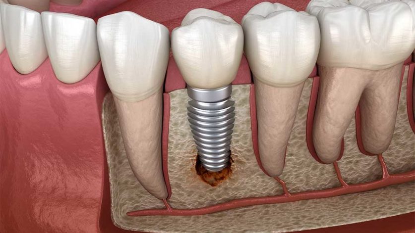 Why Should You Consider Dental Implants Healthy Mindz 6266
